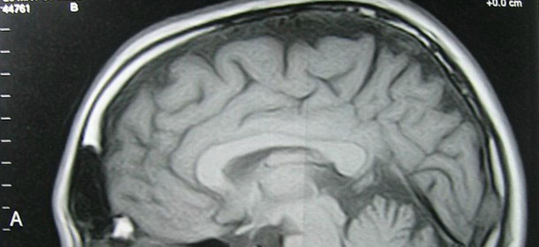 Comment une opération du cerveau peut-elle transformer une personnalité ? | Slate.fr